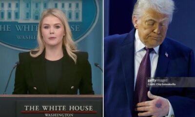 Karoline Leavitt Breaks Down as New Photos EXPOSE Trump’s Health, Showing a Worsening Bruise and Parts of His Body Appearing in Different Colors, Contradicting the Official Explanation